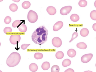 Megaloblastic-anemia