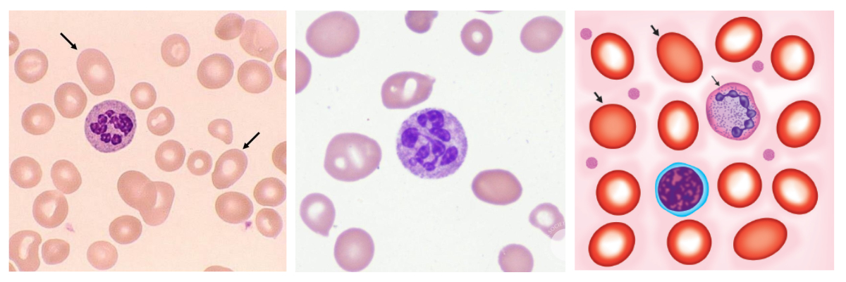 Megaloblastic-anemia