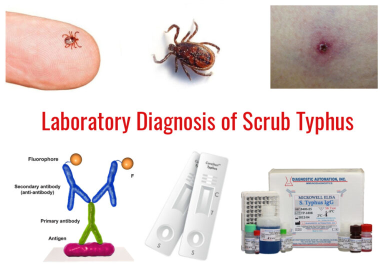 Laboratory Diagnosis Of Scrub Typhus