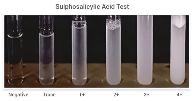 sulphosalicylic-acid-test-for-proteinuria-principle-and-procedure