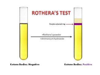 Rothera's test for ketone bodies