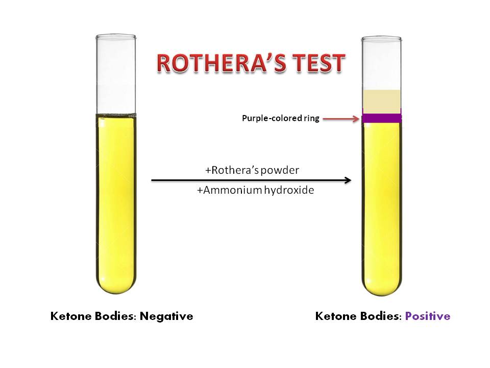 Rothera's test for ketone bodies