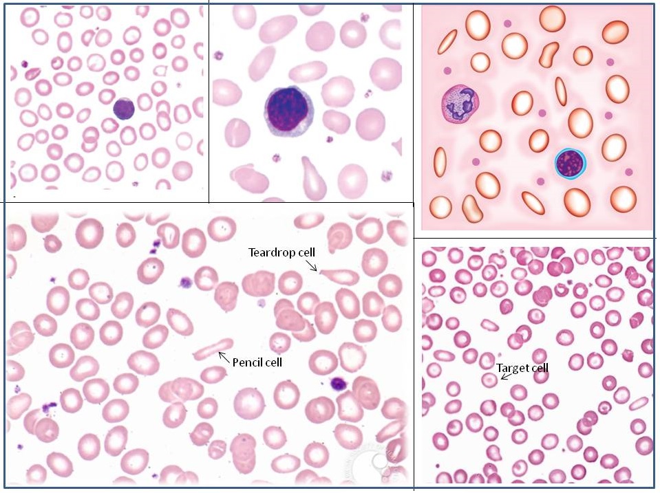 tear drop cells