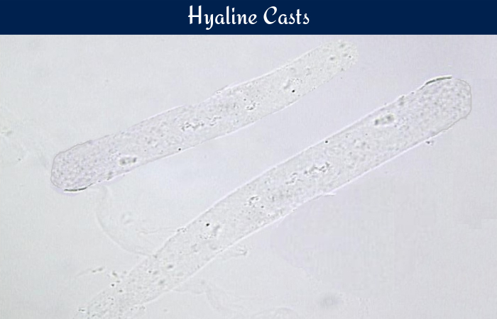 Fatty Casts In Urine