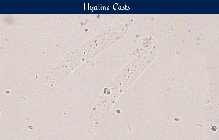 Hyaline Casts In Urine Morphology And Clinical Significance