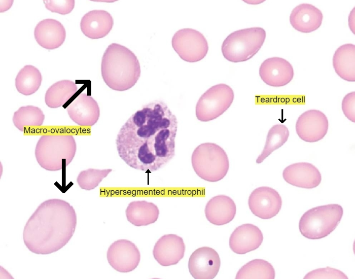 Megaloblastic-anemia