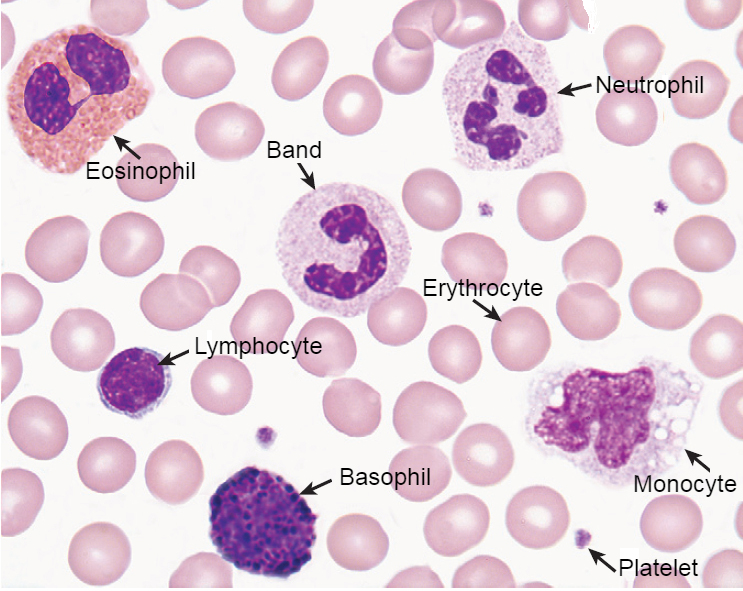 Microscopically In A Wrights Stained Peripheral Blood Smear Posters ...