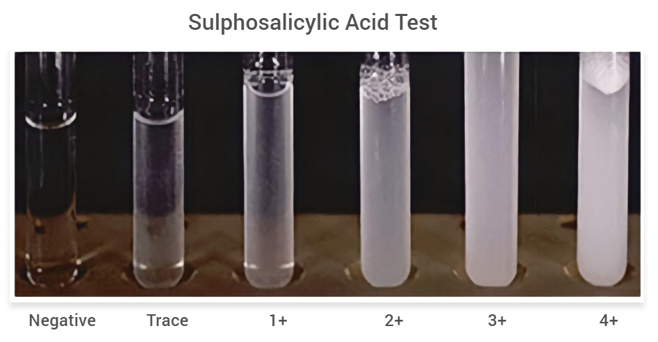 Sulphosalicylic-Acid-Test